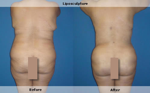 LVL, large volume liposuction